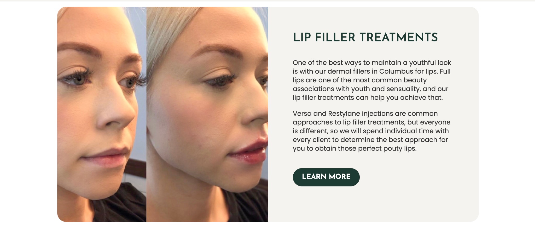 A side-by-side before and after photo showcasing the subtle, volumizing results of a lip filler treatment on a blonde woman.